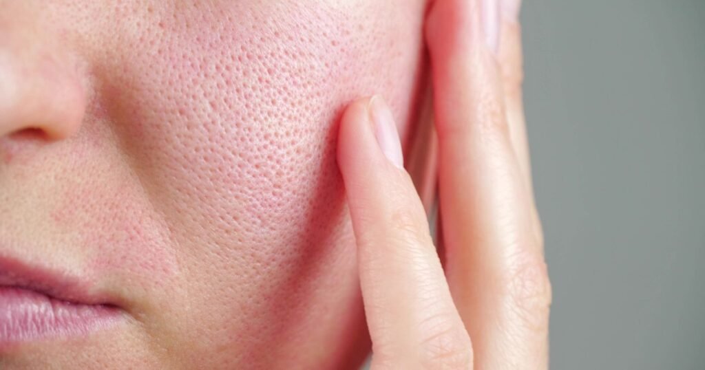 Sabañones, rosácea, dermatitis, todo empeora con el frío: 10 consejos para cuidar la piel en invierno