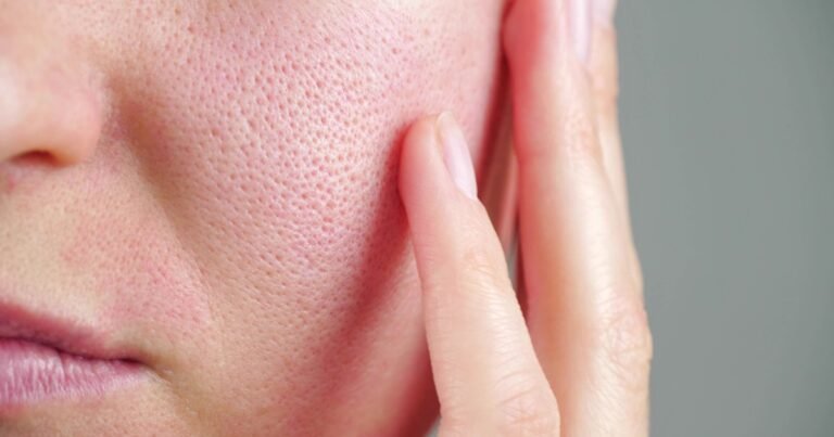 Sabañones, rosácea, dermatitis, todo empeora con el frío: 10 consejos para cuidar la piel en invierno