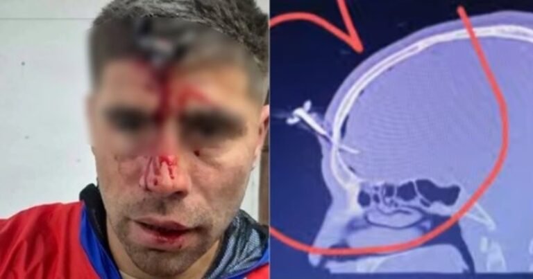 Le clavaron una llave en la cabeza a un futbolista del Ascenso durante una salvaje pelea en un torneo de fútbol femenino