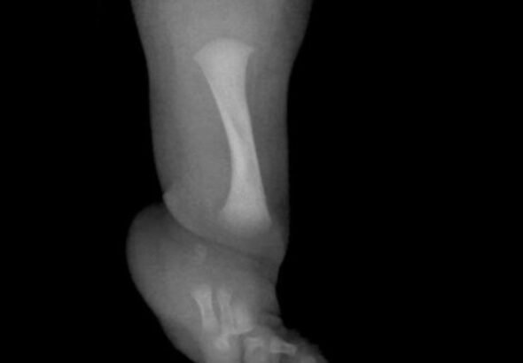 Un nene con una rara enfermedad fue operado para desarrollar un hueso fundamental