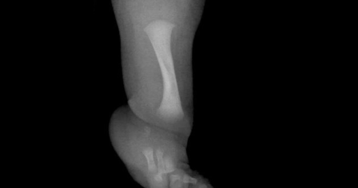 Un nene con una rara enfermedad fue operado para desarrollar un hueso fundamental