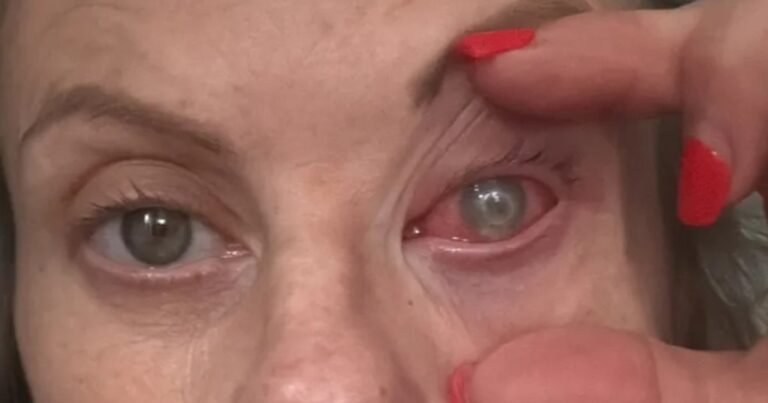 Una mujer podría perder la visión por una rara infección ocular: "Se va comiendo el ojo, la córnea y todos los nervios"