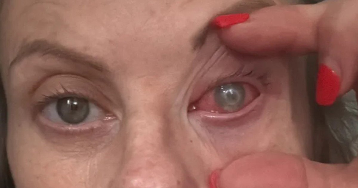 Una mujer podría perder la visión por una rara infección ocular: "Se va comiendo el ojo, la córnea y todos los nervios"