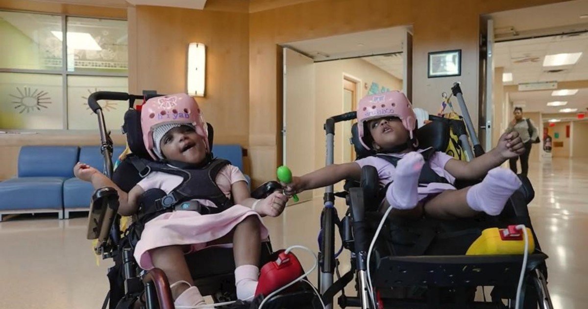 Hito de la medicina | Dos bebés siamesas unidas por la cabeza pudieron ser separadas tras una compleja cirugía de más de 24 horas en Estados Unidos: "Es realmente extraordinario"